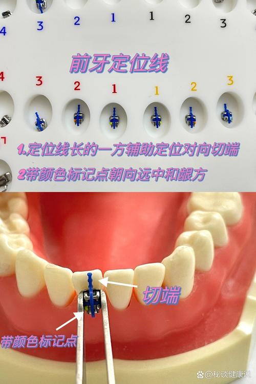护士正畸粘托槽流程的关键步骤有哪些？-图3