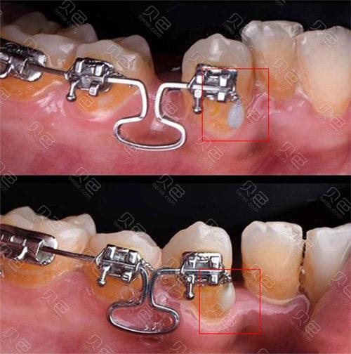 正畸尖牙回扎方法-图2 正畸尖牙回扎方法-图2