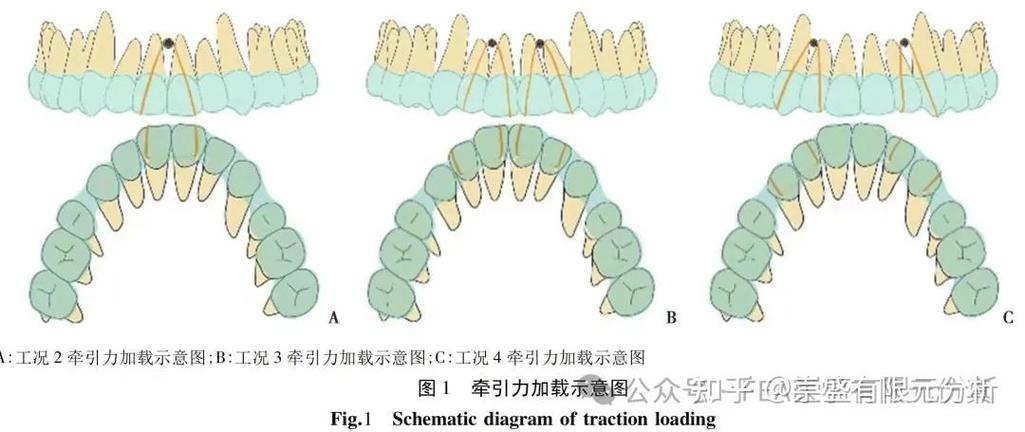 临床上如何有效实现上颌6的压低？-图2