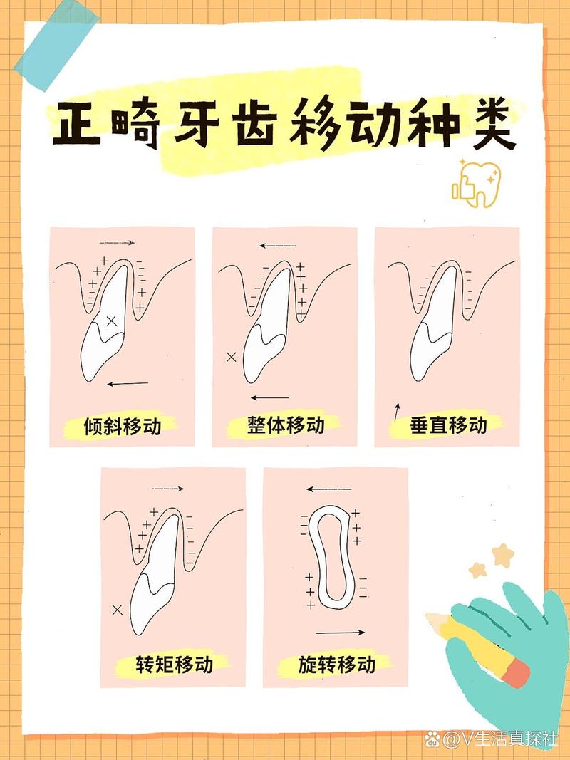 正畸最常见的牙齿移动方式是什么？-图1