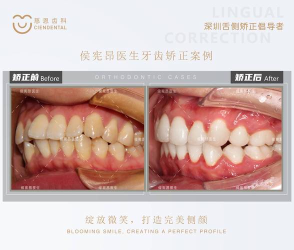 正畸拍摄照片的正确方法有哪些？-图1