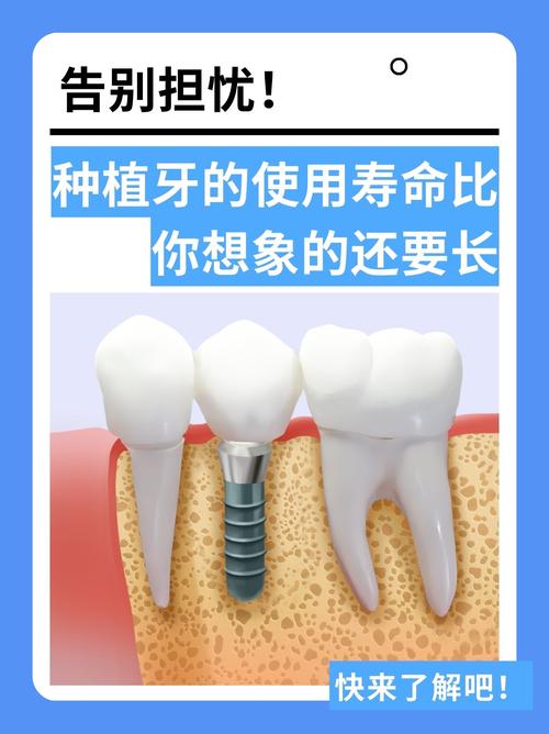 种牙寿命到底能维持多久?哪些因素会影响其长短?-图2 种牙寿命到底能维持多久?哪些因素会影响其长短?-图2