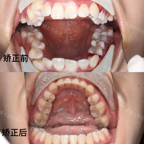 正畸中咬合问题频发？如何科学应对与调整？-图1