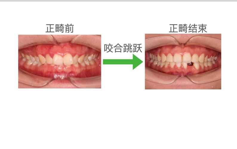 正畸中咬合问题频发？如何科学应对与调整？-图3
