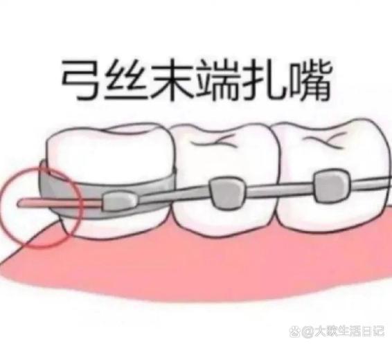 正畸结扎的正确方法是什么？操作步骤有哪些？-图1