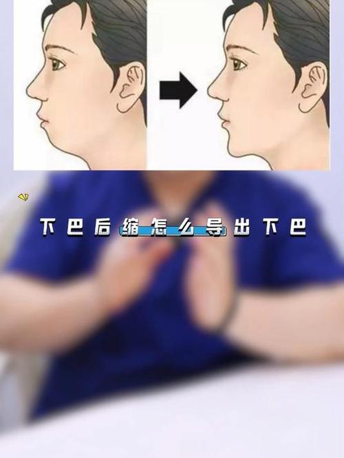 下颌曲线反了,正畸矫正有哪些注意事项?-图3 下颌曲线反了,正畸矫正有哪些注意事项?-图3