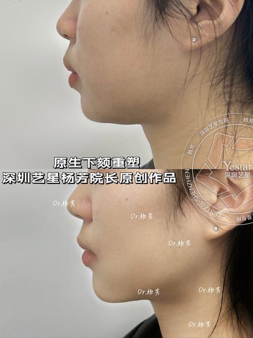 下颌曲线反了,正畸矫正有哪些注意事项?-图2 下颌曲线反了,正畸矫正有哪些注意事项?-图2