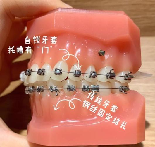 口腔矫治结扎方法如何选择与规范操作？-图3