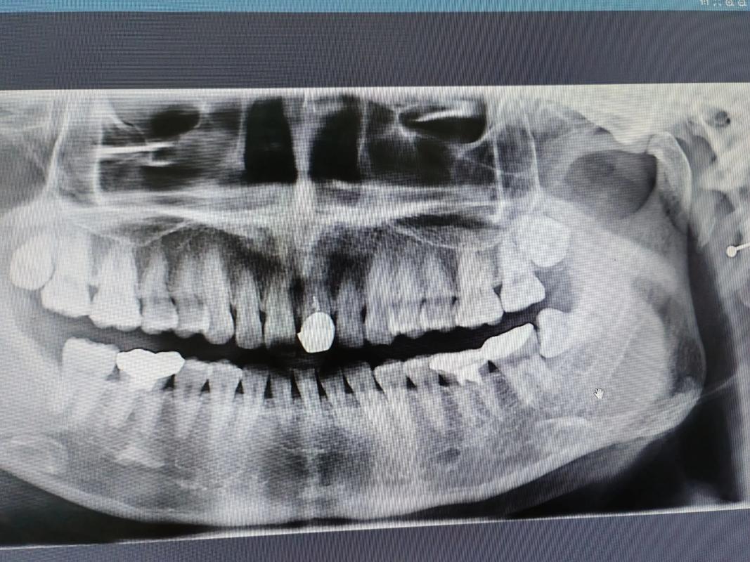 正畸拍口腔CT是必须的吗？检查有必要吗？-图2