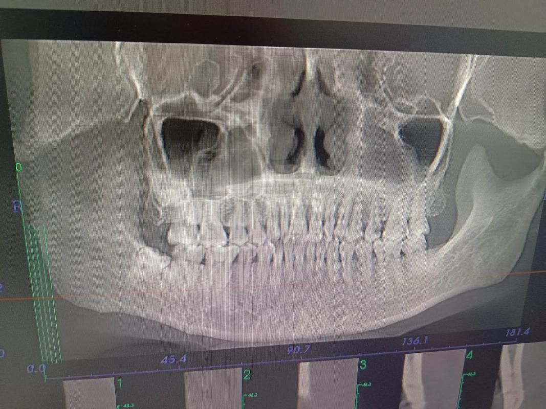 正畸拍口腔CT是必须的吗？检查有必要吗？-图3