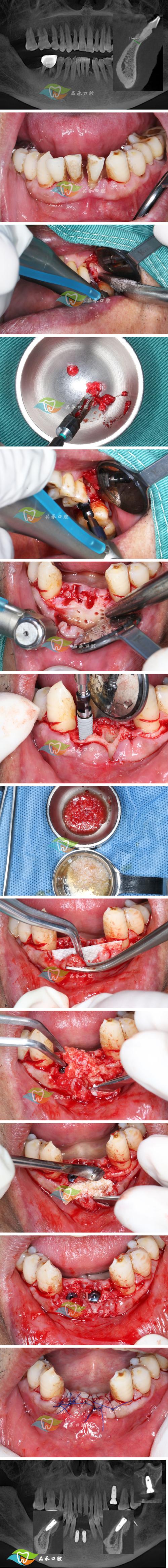 正畸与引导组织再生术-图2