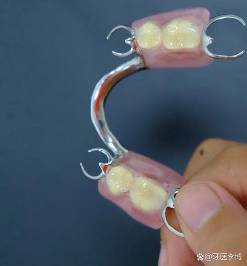 活动义齿就位方法有哪些实用操作步骤和技巧？-图2