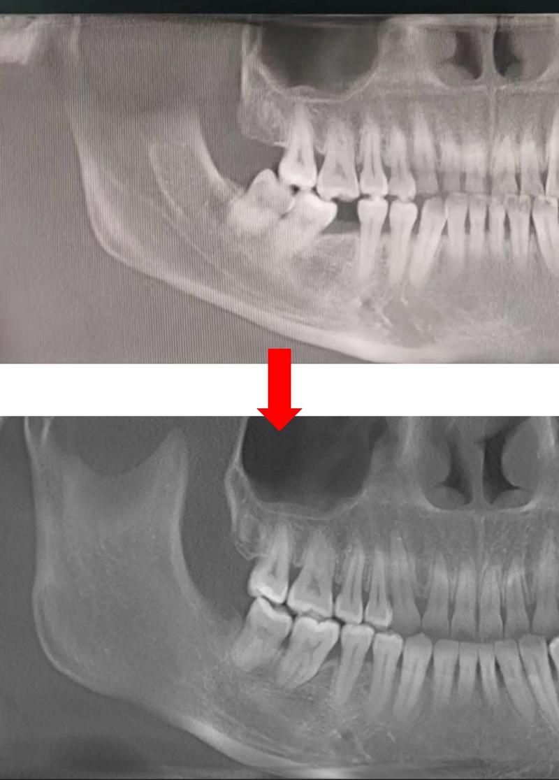 正畸智齿代替第一磨牙可行吗？效果如何？-图2