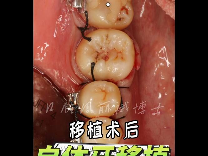 正畸智齿代替第一磨牙可行吗？效果如何？-图1