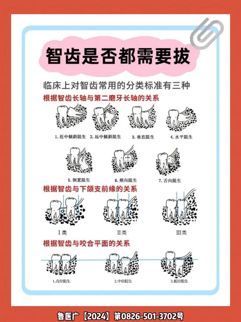 成人智齿拔除方法-图2 成人智齿拔除方法-图2