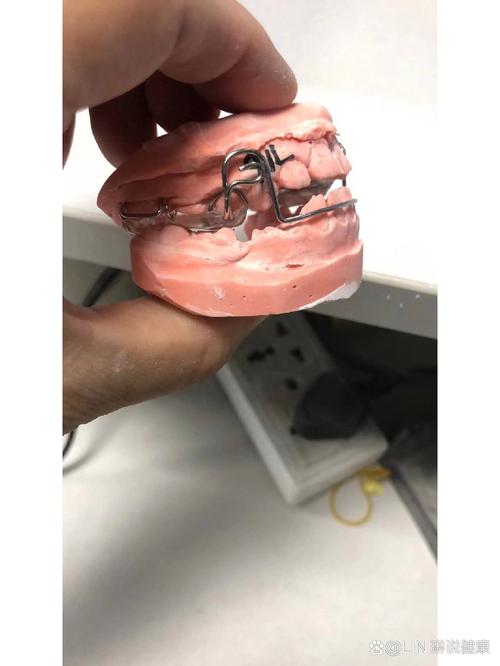 口外正畸牵引装置腔内应用有哪些注意事项？-图1