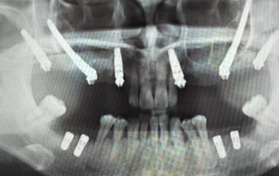 离上颌骨近种牙风险大吗?如何安全种植不伤骨?-图1 离上颌骨近种牙风险大吗?如何安全种植不伤骨?-图1