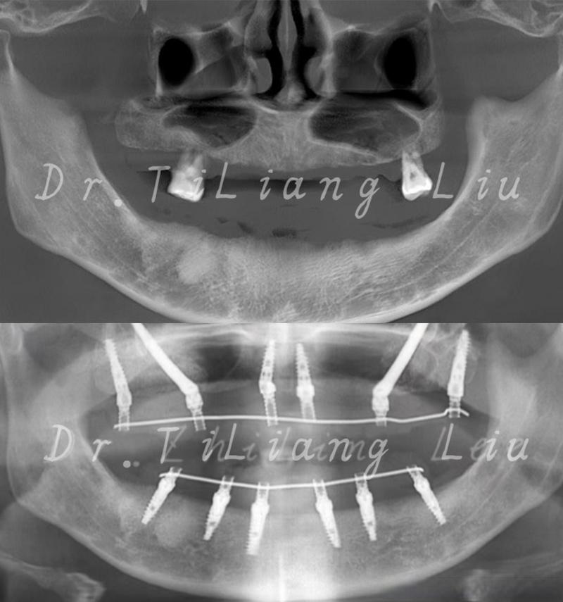 离上颌骨近种牙风险大吗?如何安全种植不伤骨?-图2 离上颌骨近种牙风险大吗?如何安全种植不伤骨?-图2