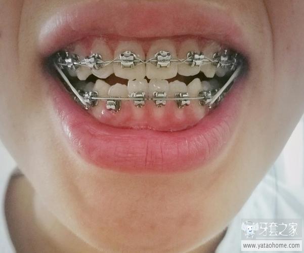 成都华美蒋馨正畸医生技术怎么样？-图2