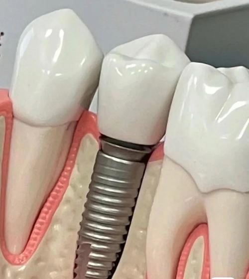 精密附着体种牙的优势体现在哪些方面？-图1