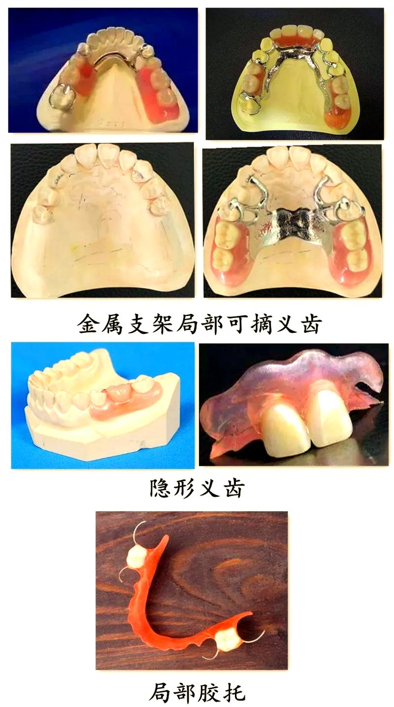 固定假牙护理方法-图3