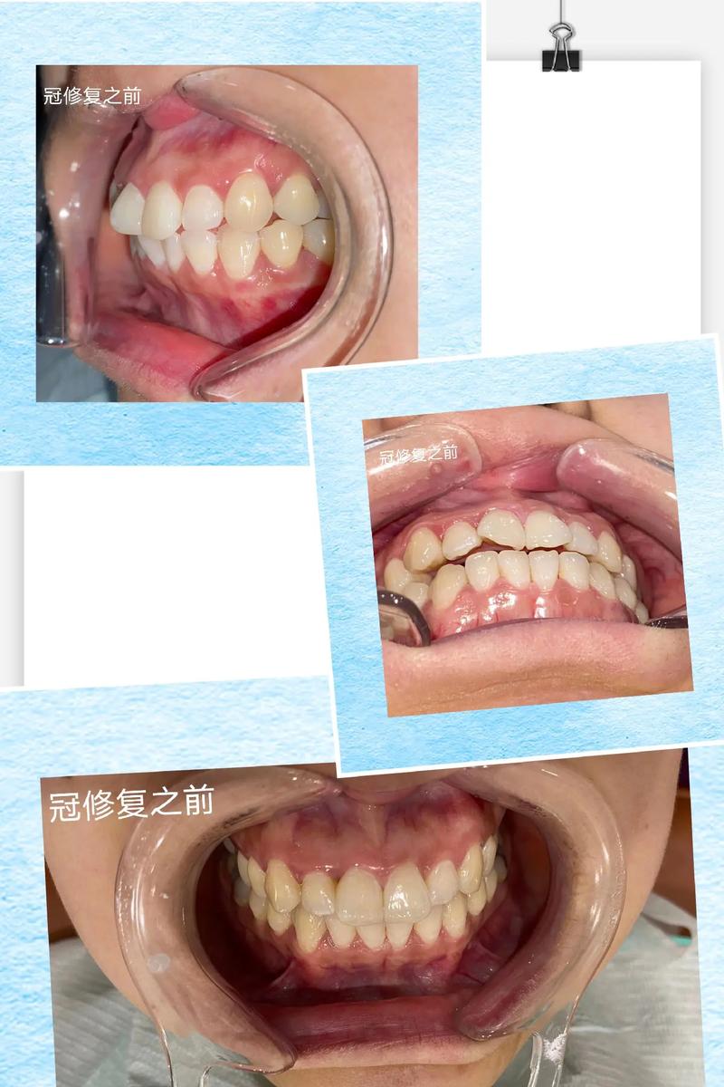 牙齿扭转的治疗方法有哪些具体方案？-图1