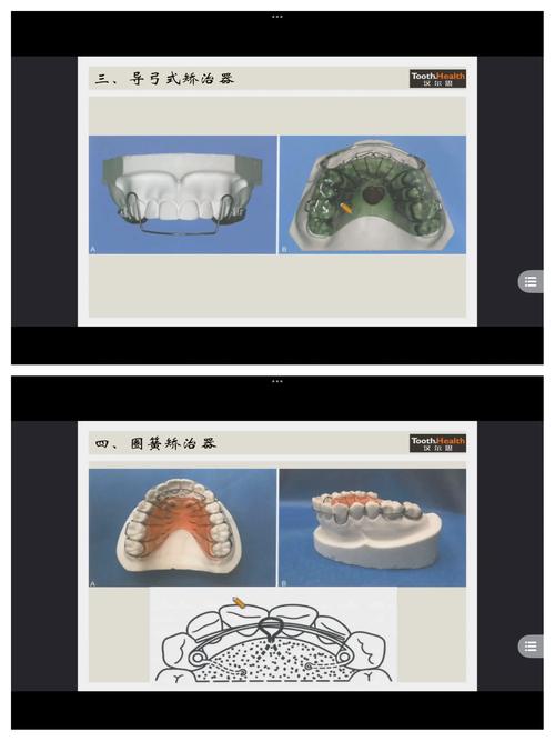 牙床畸形治疗方法-图1 牙床畸形治疗方法-图1