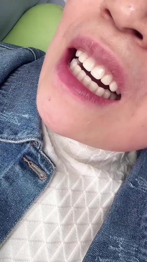 全口义齿修复,种牙真的是更好选择吗?-图2 全口义齿修复,种牙真的是更好选择吗?-图2