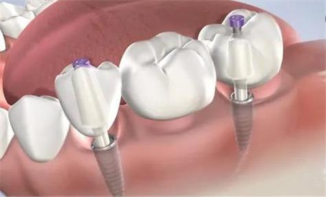 搭桥和种牙哪个好？选择关键看什么？-图1