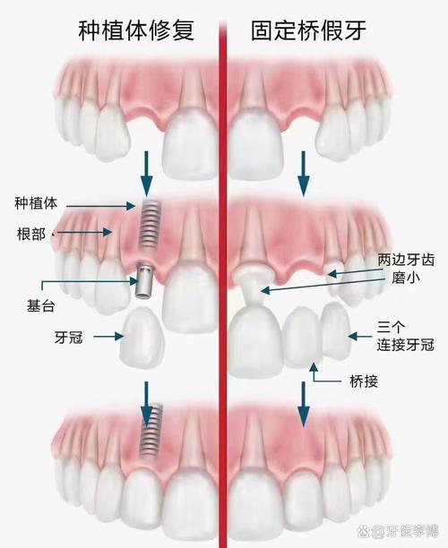 搭桥和种牙哪个好？选择关键看什么？-图2