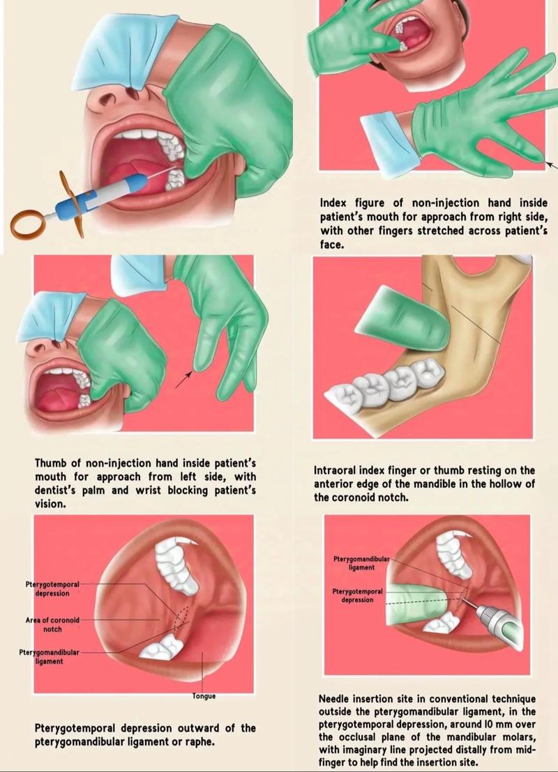 儿童口腔麻醉有哪些安全有效的方法？-图1