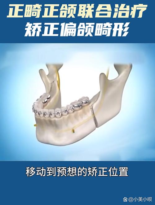 正畸治疗中骨头内部重建的具体过程是怎样的？-图1