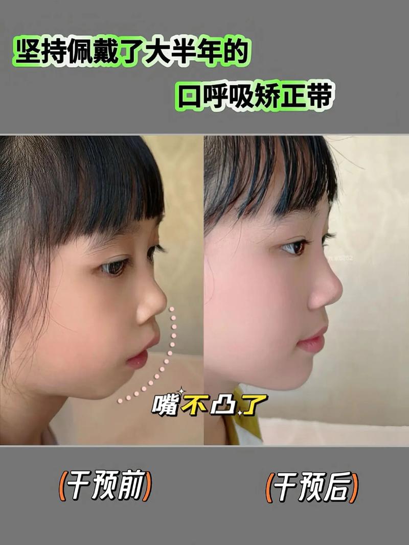青少年口呼吸面容正畸能矫正出好脸型吗？-图2