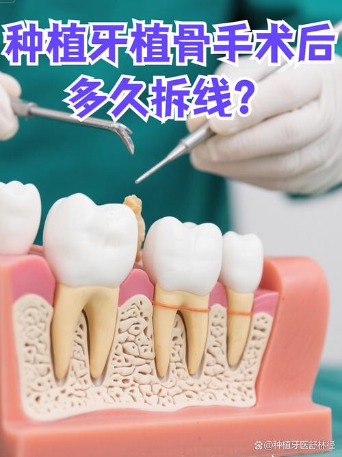 种牙后拆线时间多久?拆线时机有讲究吗?-图2 种牙后拆线时间多久?拆线时机有讲究吗?-图2