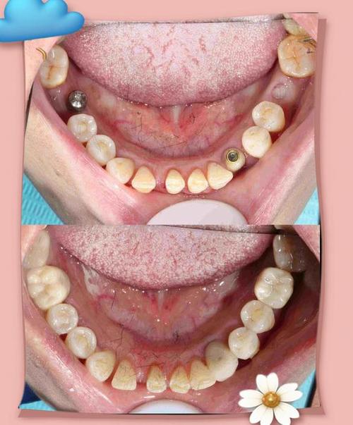 种牙钉子帽掉了是何原因？需重新处理吗？-图2