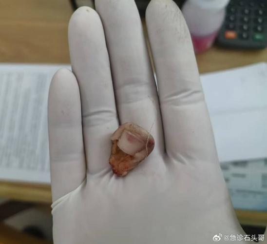 种牙钉子帽掉了是何原因？需重新处理吗？-图1