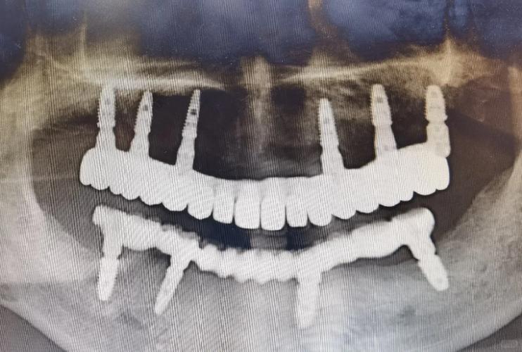 杭州全口种牙技术怎么选更靠谱？-图3
