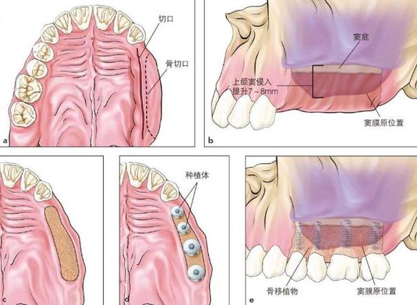 牙床窄可以种牙吗？窄牙床种牙需要什么条件？-图3