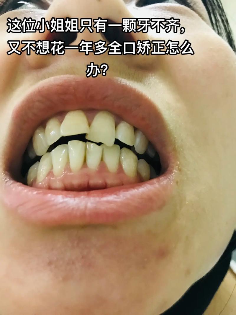 门牙不齐，哪种矫正方法最有效？如何选？-图1