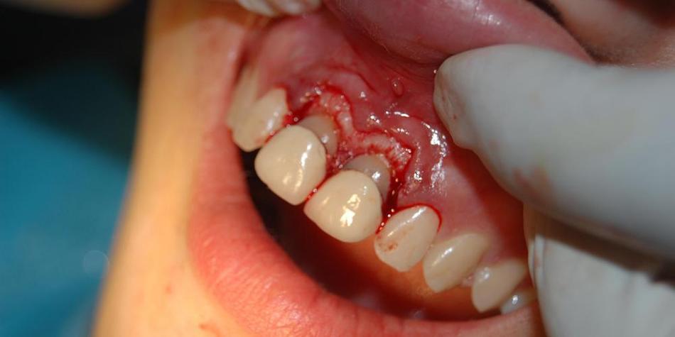 牙冠延长手术的常用方法具体有哪些呢？-图2