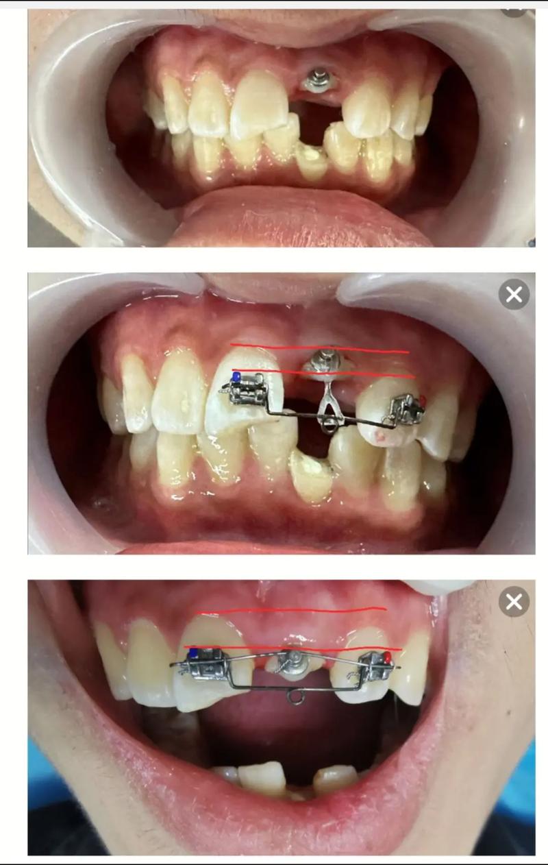 牙冠延长手术的常用方法具体有哪些呢？-图1
