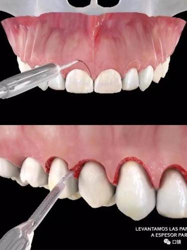 牙冠延长手术的常用方法具体有哪些呢？-图3