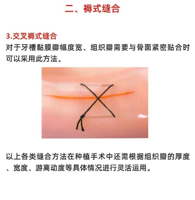口腔常见缝合方法有哪些类型及适用场景？-图2