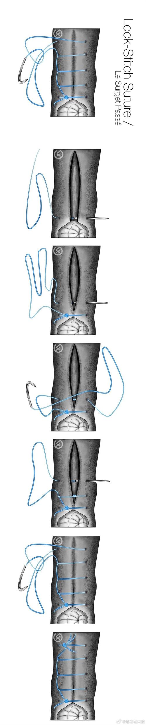 口腔常见缝合方法有哪些类型及适用场景？-图3