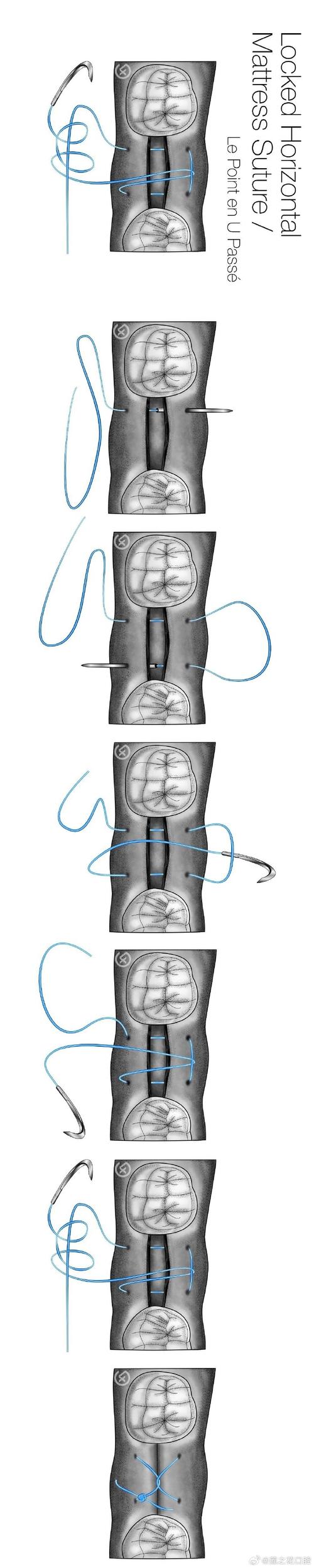 口腔常见缝合方法有哪些类型及适用场景？-图1