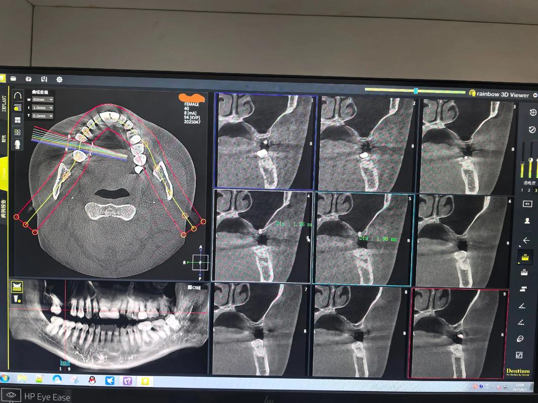 在进行种牙手术时,上颌骨厚度会受到怎样的影响?-图1 在进行种牙手术时,上颌骨厚度会受到怎样的影响?-图1