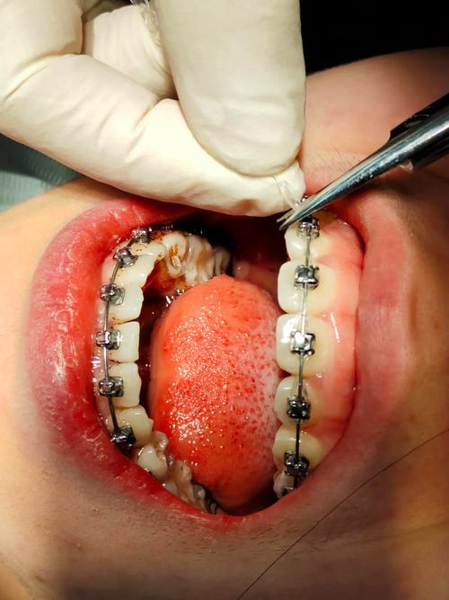 轻微反颌正畸需要多久-图1 轻微反颌正畸需要多久-图1