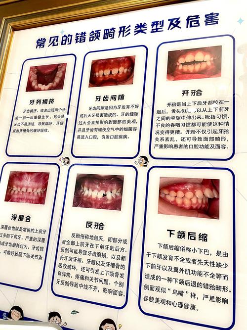 轻微反颌正畸需要多久-图3 轻微反颌正畸需要多久-图3