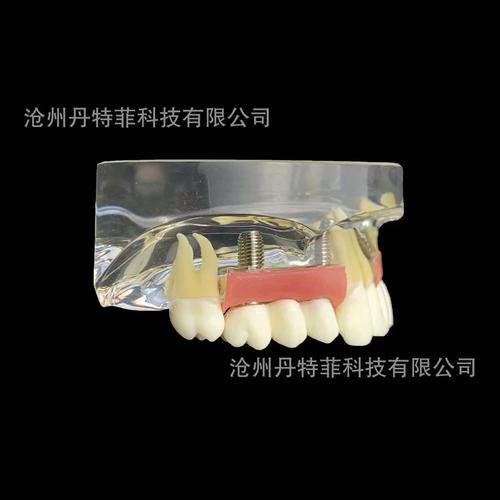 种牙取模型的条件-图2