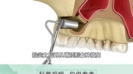 种牙外提手术视频能看清哪些关键步骤？-图1